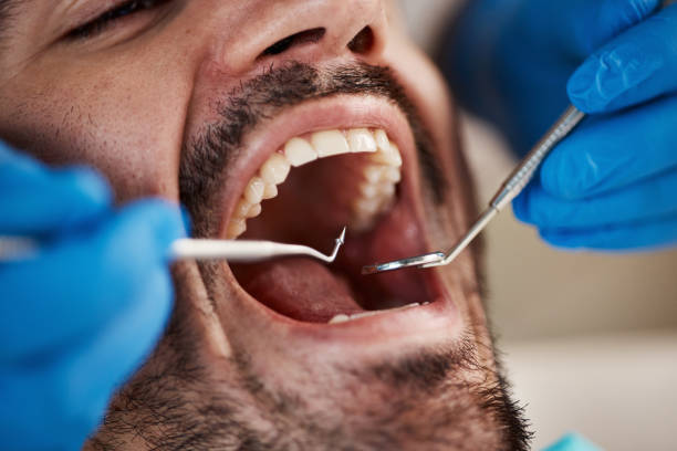 Best Knocked-Out Tooth (Avulsed Tooth) Treatment in Marmet, WV