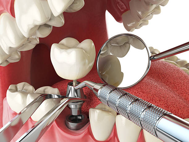 Best Broken or Chipped Tooth Repair in Marmet, WV